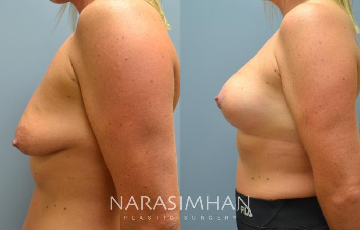 Before & After Breast Augmentation with Lift (Mastopexy) Case 12 View #3 View in St Petersburg, Florida
