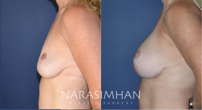 Before & After Breast Augmentation with Lift (Mastopexy) Case 177 View #2 View in St Petersburg, Florida