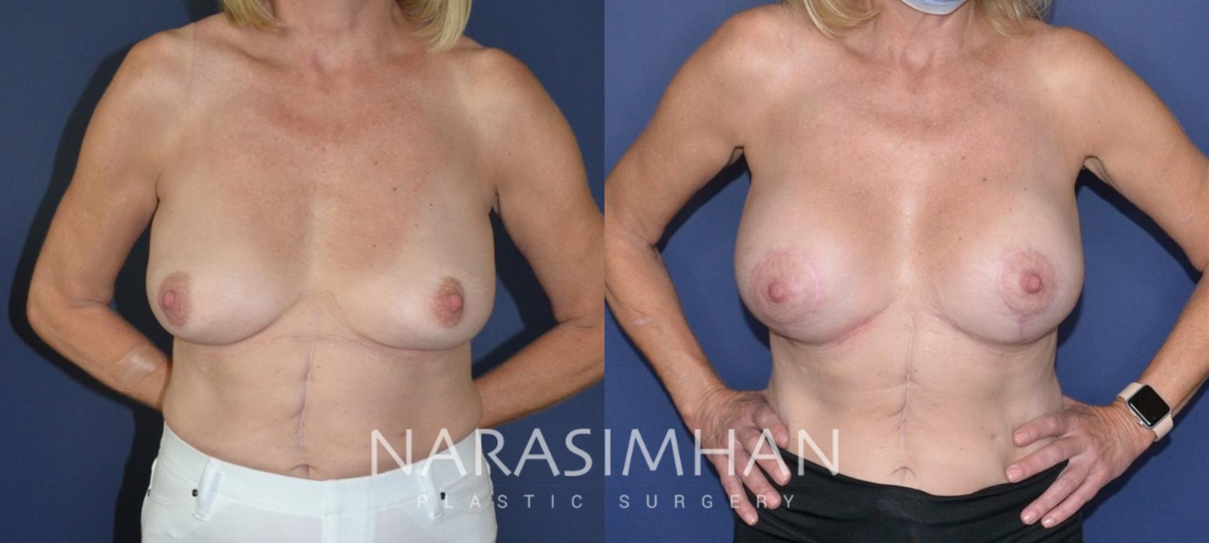 Before & After Breast Augmentation with Lift (Mastopexy) Case 198 View #1 View in Tampa, Florida