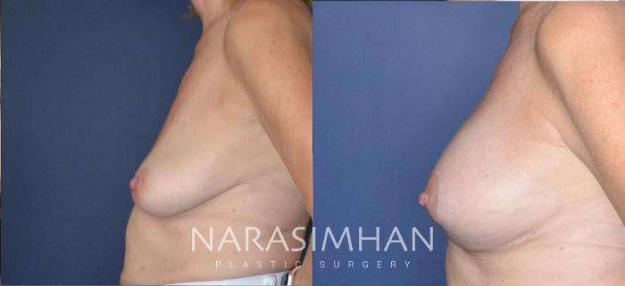 Before & After Breast Augmentation with Lift (Mastopexy) Case 198 View #2 View in Tampa, Florida