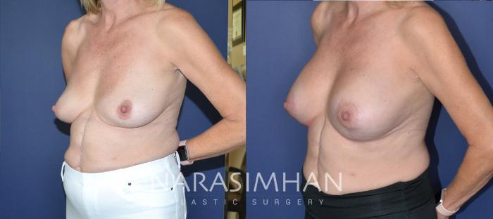 Before & After Mastopexy Case 198 View #3 View in Tampa, Florida