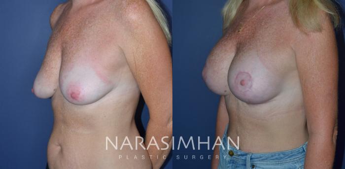 Before & After Breast Augmentation with Lift (Mastopexy) Case 239 View #2 View in St Petersburg, Florida