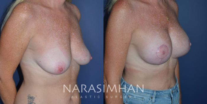 Before & After Breast Augmentation with Lift (Mastopexy) Case 239 View #3 View in St Petersburg, Florida