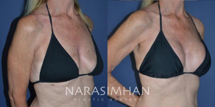 Before & After Breast Augmentation with Lift (Mastopexy) Case 244 View #4 View in St Petersburg, Florida