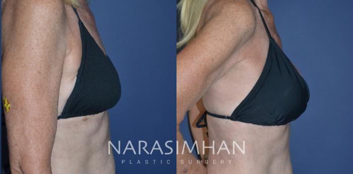 Before & After Breast Augmentation with Lift (Mastopexy) Case 244 View #6 View in St Petersburg, Florida