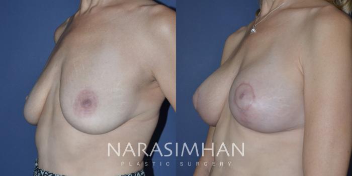 Before & After Breast Augmentation with Lift (Mastopexy) Case 274 View #2 View in St Petersburg, Florida
