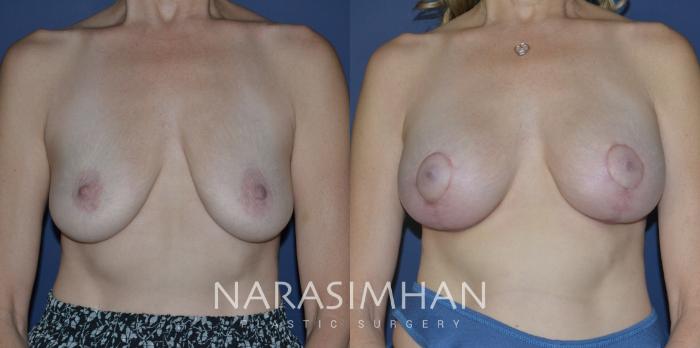 Before & After Breast Augmentation with Lift (Mastopexy) Case 274 View #3 View in St Petersburg, Florida