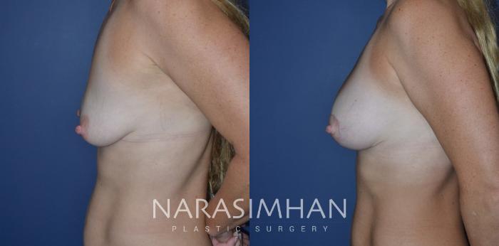 Before & After Breast Augmentation with Lift (Mastopexy) Case 283 Left Side View in Tampa, Florida