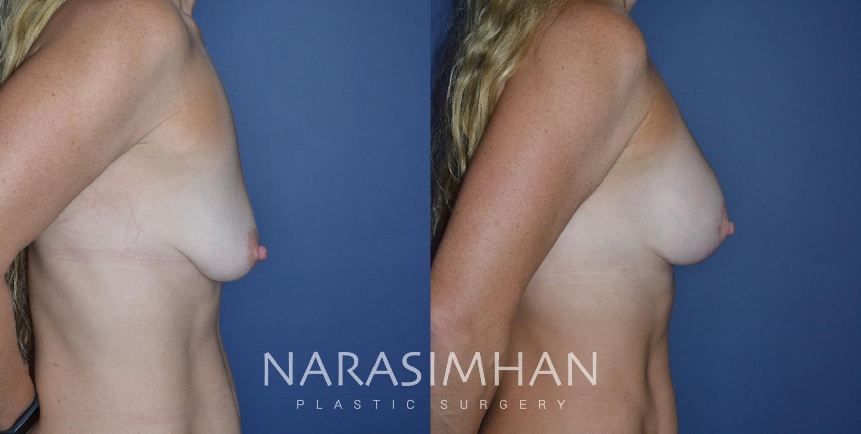 Before & After Breast Augmentation with Lift (Mastopexy) Case 283 Right Side View in Tampa, Florida