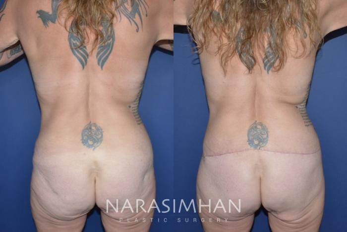 Before & After Post-Weight Loss / Post-Bariatric Skin Tightening Case 290 Back View in St Petersburg, Florida