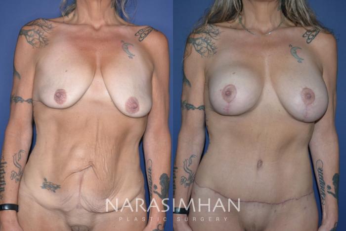 Before & After Post-Weight Loss / Post-Bariatric Skin Tightening Case 290 Front View in St Petersburg, Florida