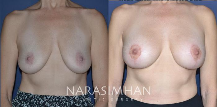 Before & After Breast Augmentation with Lift (Mastopexy) Case 300 Front View in St Petersburg, Florida