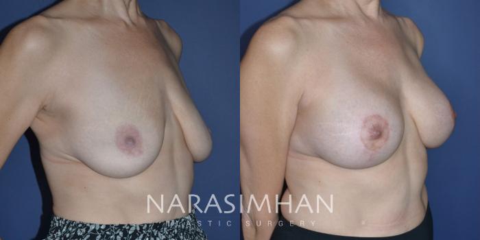 Before & After Breast Augmentation with Lift (Mastopexy) Case 300 Right Oblique View in St Petersburg, Florida