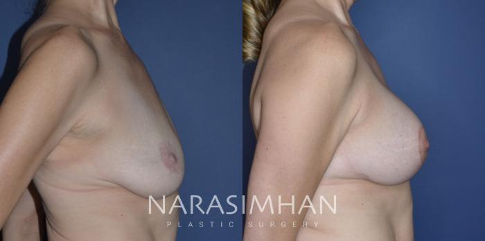 Before & After Breast Augmentation with Lift (Mastopexy) Case 300 Right Side View in St Petersburg, Florida