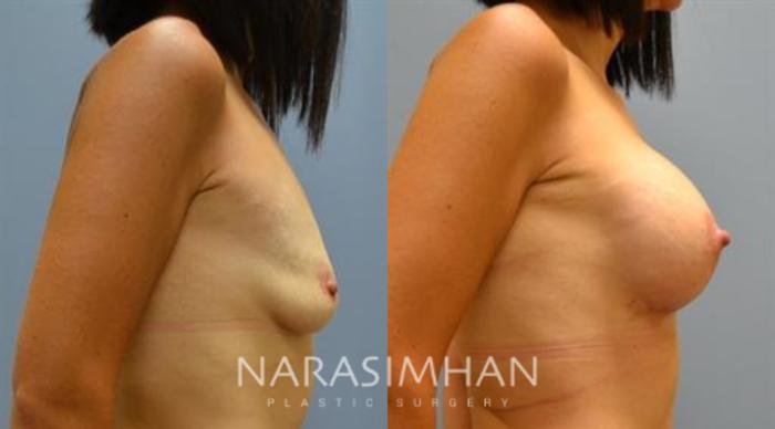 Before & After Breast Augmentation with Lift (Mastopexy) Case 33 View #2 View in St Petersburg, Florida