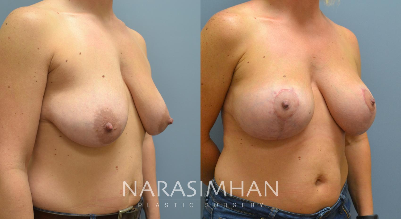 Before & After Breast Augmentation with Lift (Mastopexy) Case 50 View #1 View in St Petersburg, Florida