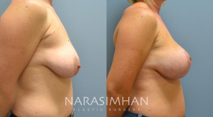 Before & After Breast Augmentation with Lift (Mastopexy) Case 50 View #2 View in St Petersburg, Florida