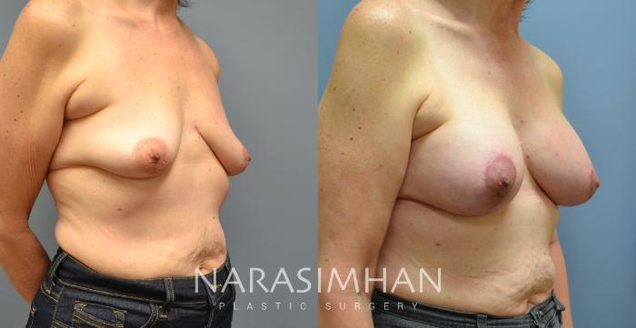 Before & After Breast Augmentation with Lift (Mastopexy) Case 52 View #2 View in St Petersburg, Florida
