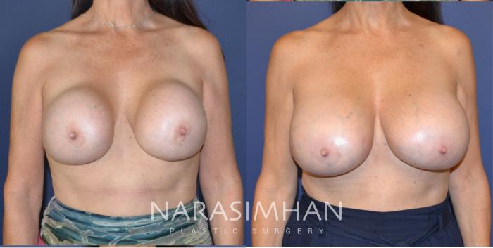 Before & After Breast Implant Revision Case 165 View #1 View in St Petersburg, Florida