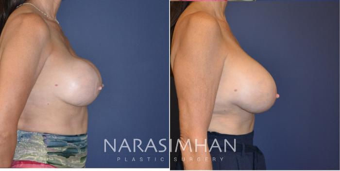 Before & After Breast Implant Revision Case 165 View #2 View in Tampa, Florida