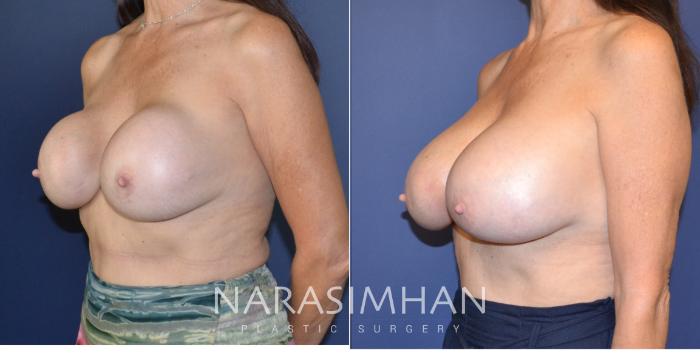 Before & After Breast Implant Revision Case 165 View #3 View in Tampa, Florida