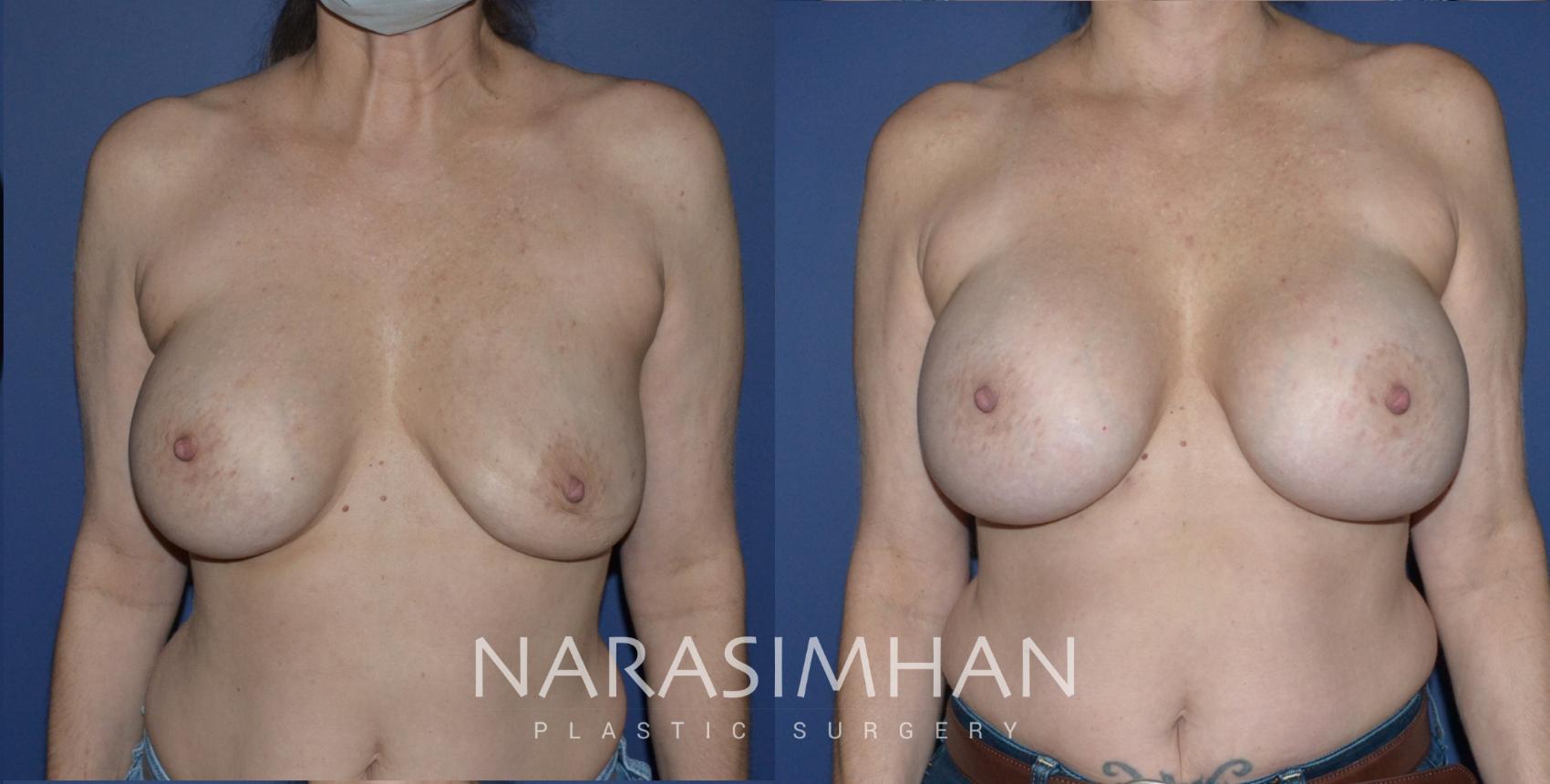 Before & After Breast Implant Revision Case 240 View #1 View in St Petersburg, Florida