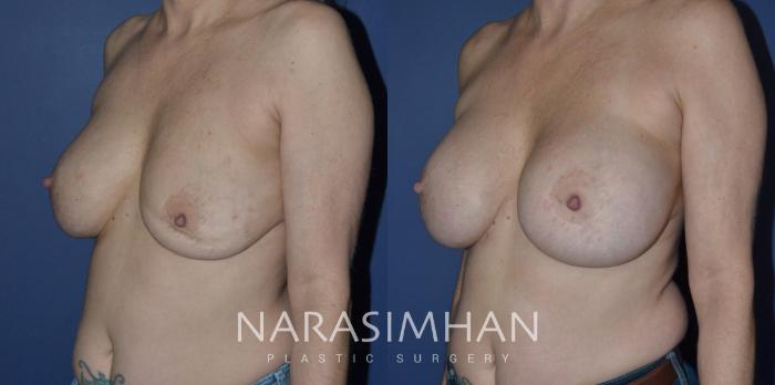 Before & After Breast Implant Revision Case 240 View #2 View in Tampa, Florida