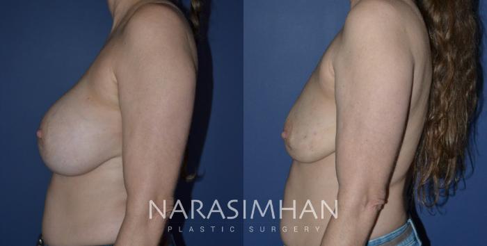 Before & After Breast Implant Revision Case 240 View #3 View in Tampa, Florida