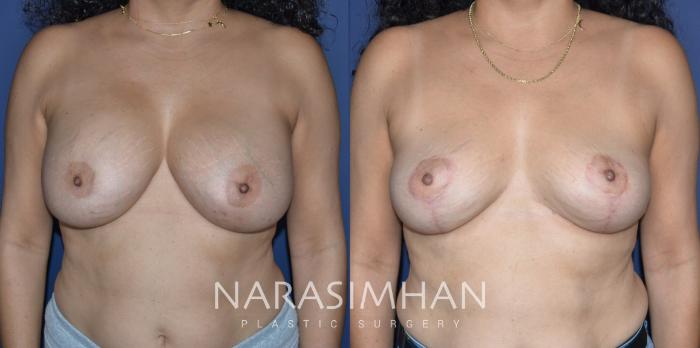 Before & After Breast Implant Revision Case 310 Front View in Tampa, Florida