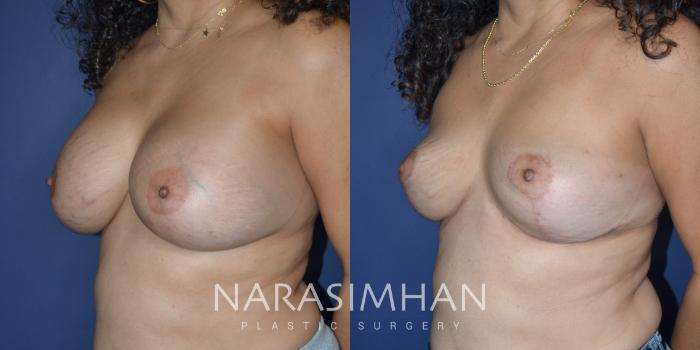 Before & After Breast Implant Revision Case 310 Left Oblique View in Tampa, Florida
