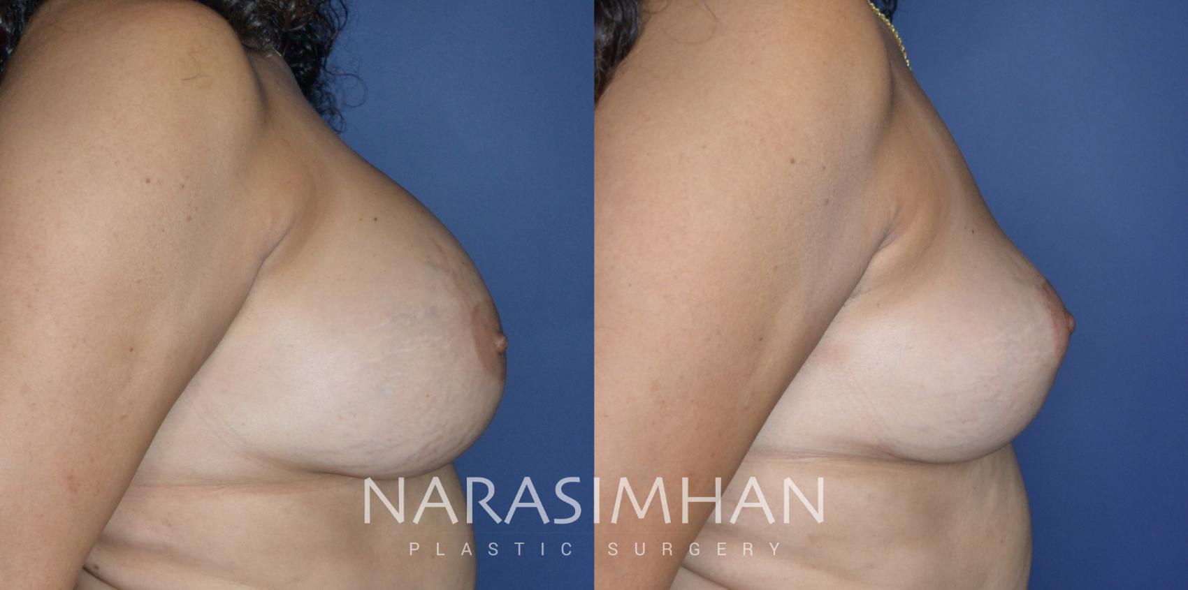 Before & After Mastopexy Case 310 Right Side View in Tampa, Florida