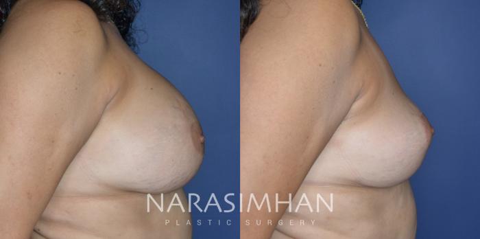 Before & After Breast Implant Revision Case 310 Right Side View in St Petersburg, Florida