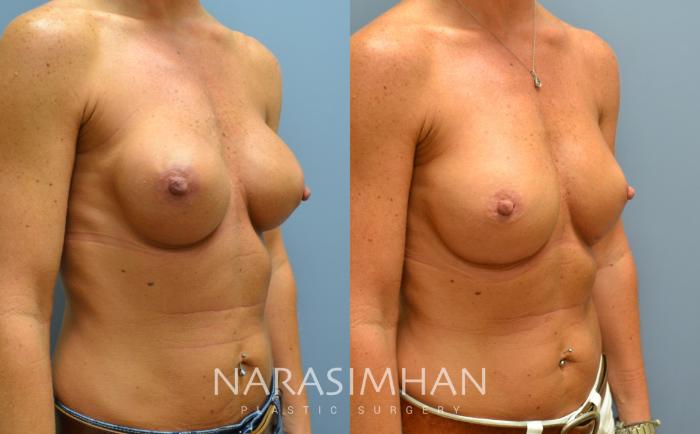 Before & After Breast Implant Revision Case 46 View #2 View in Tampa, Florida