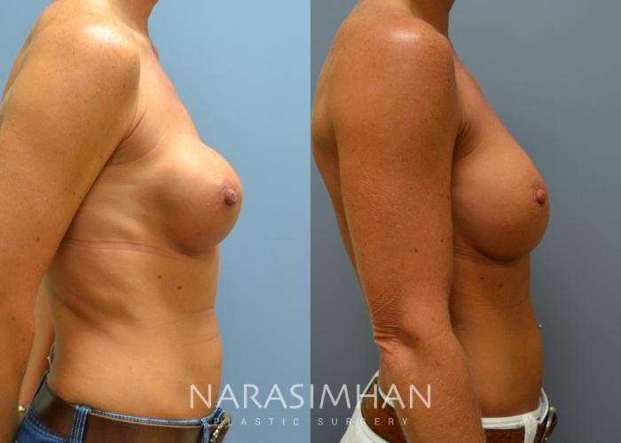Before & After Breast Implant Revision Case 46 View #3 View in Tampa, Florida