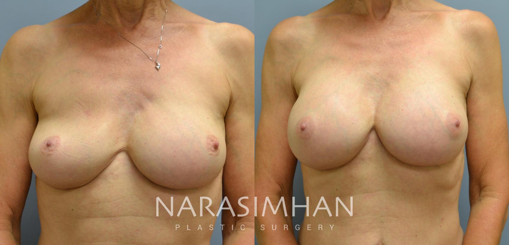 Before & After Breast Implant Revision Case 47 View #1 View in St Petersburg, Florida