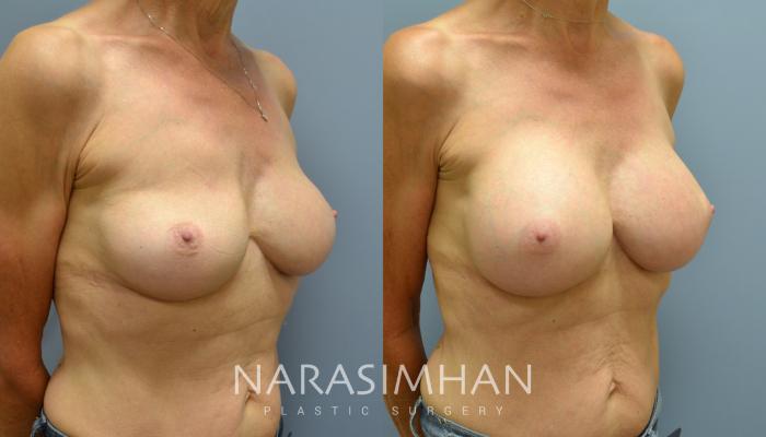 Before & After Breast Implant Revision Case 47 View #2 View in Tampa, Florida