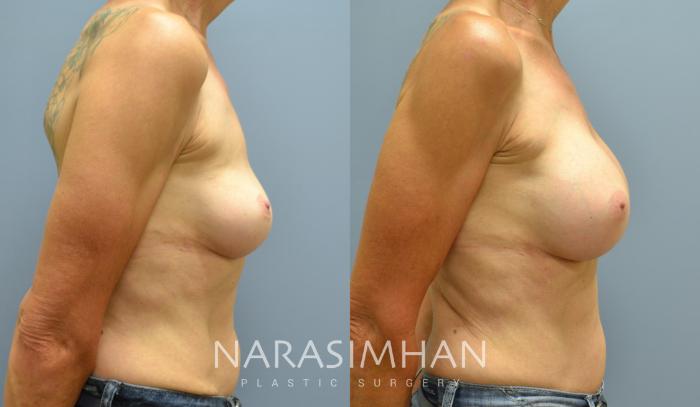 Before & After Breast Implant Revision Case 47 View #3 View in Tampa, Florida