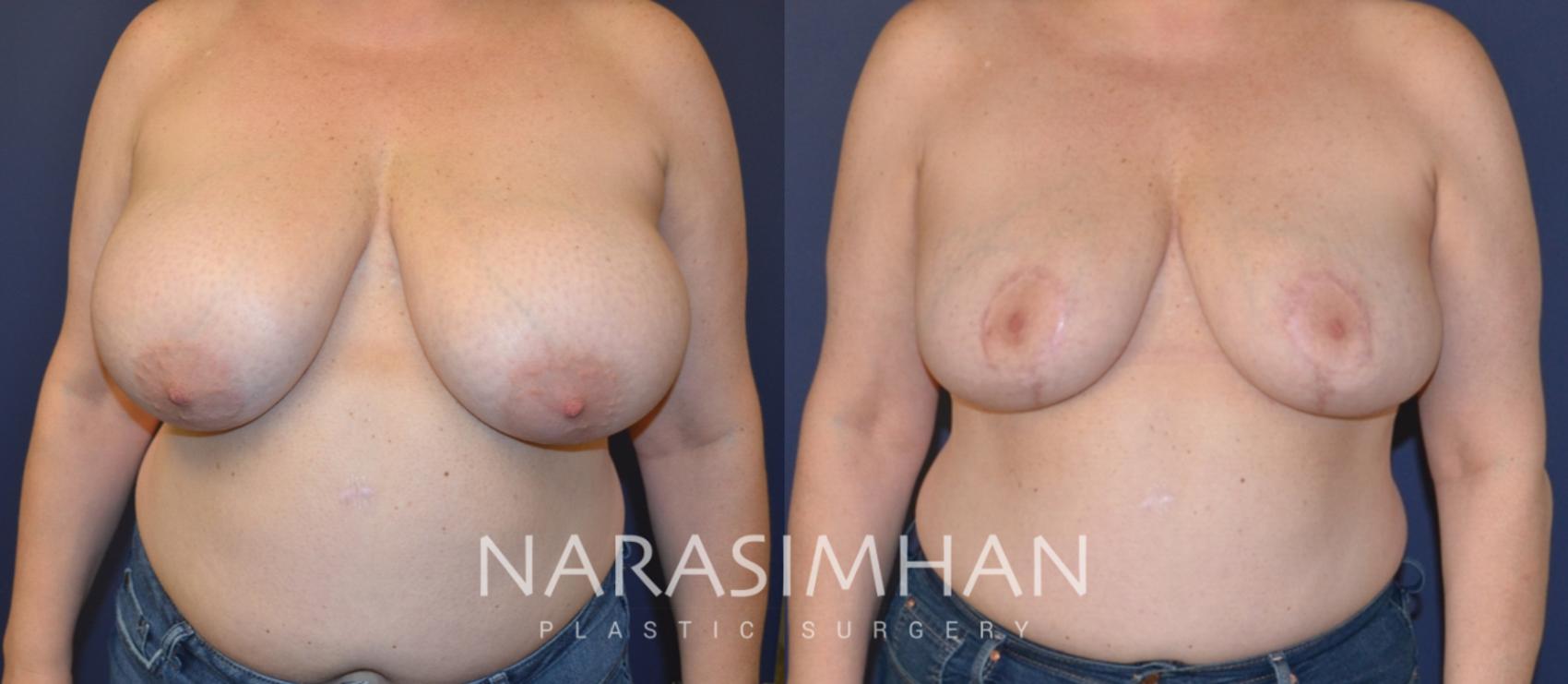Before & After Breast Reduction Case 148 View #1 View in St. Petersburg, Florida