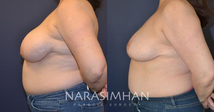 Before & After Breast Reduction Case 148 View #2 View in Tampa, Florida