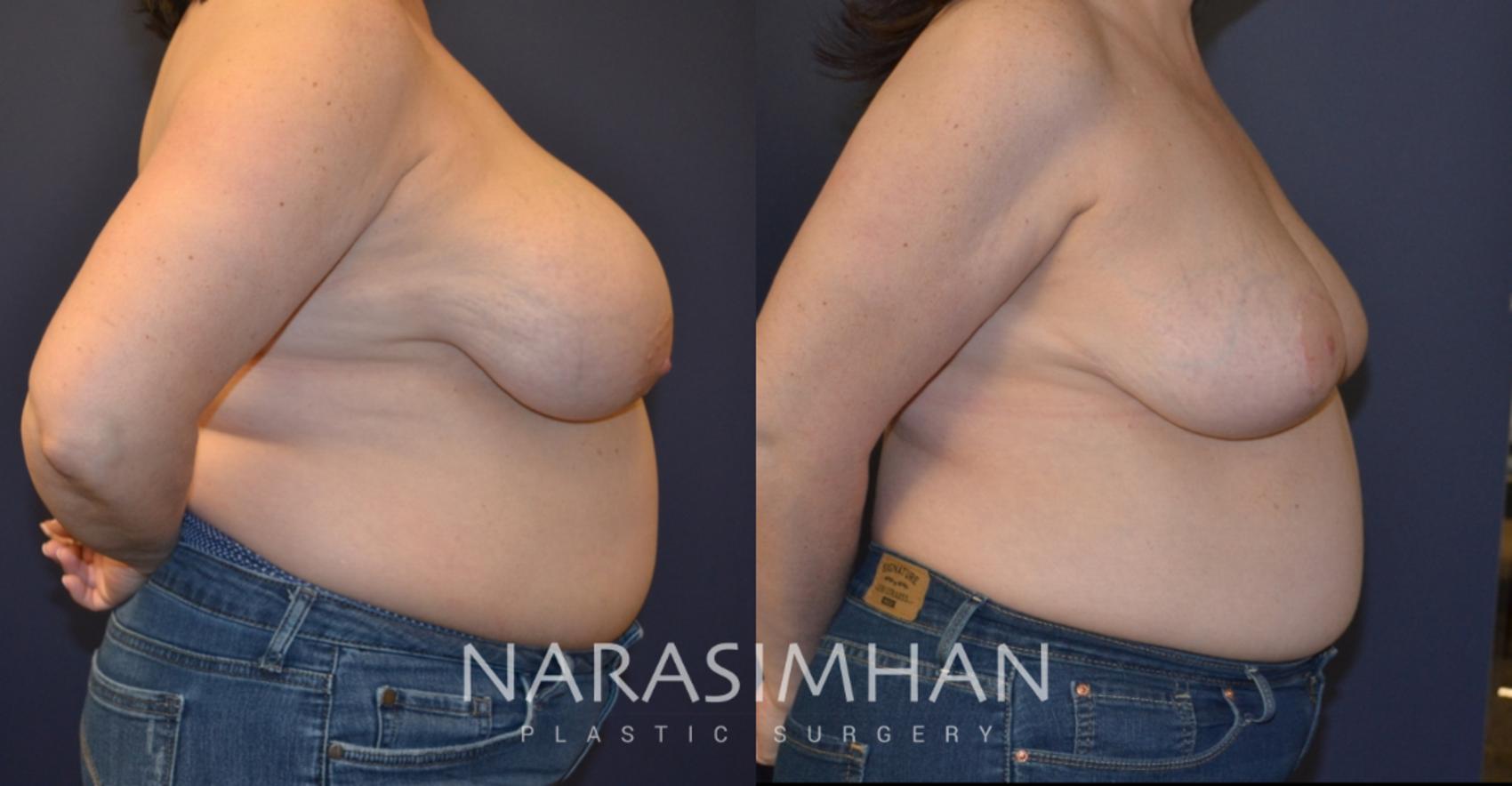Before & After Breast Reduction Case 148 View #3 View in St. Petersburg, Florida