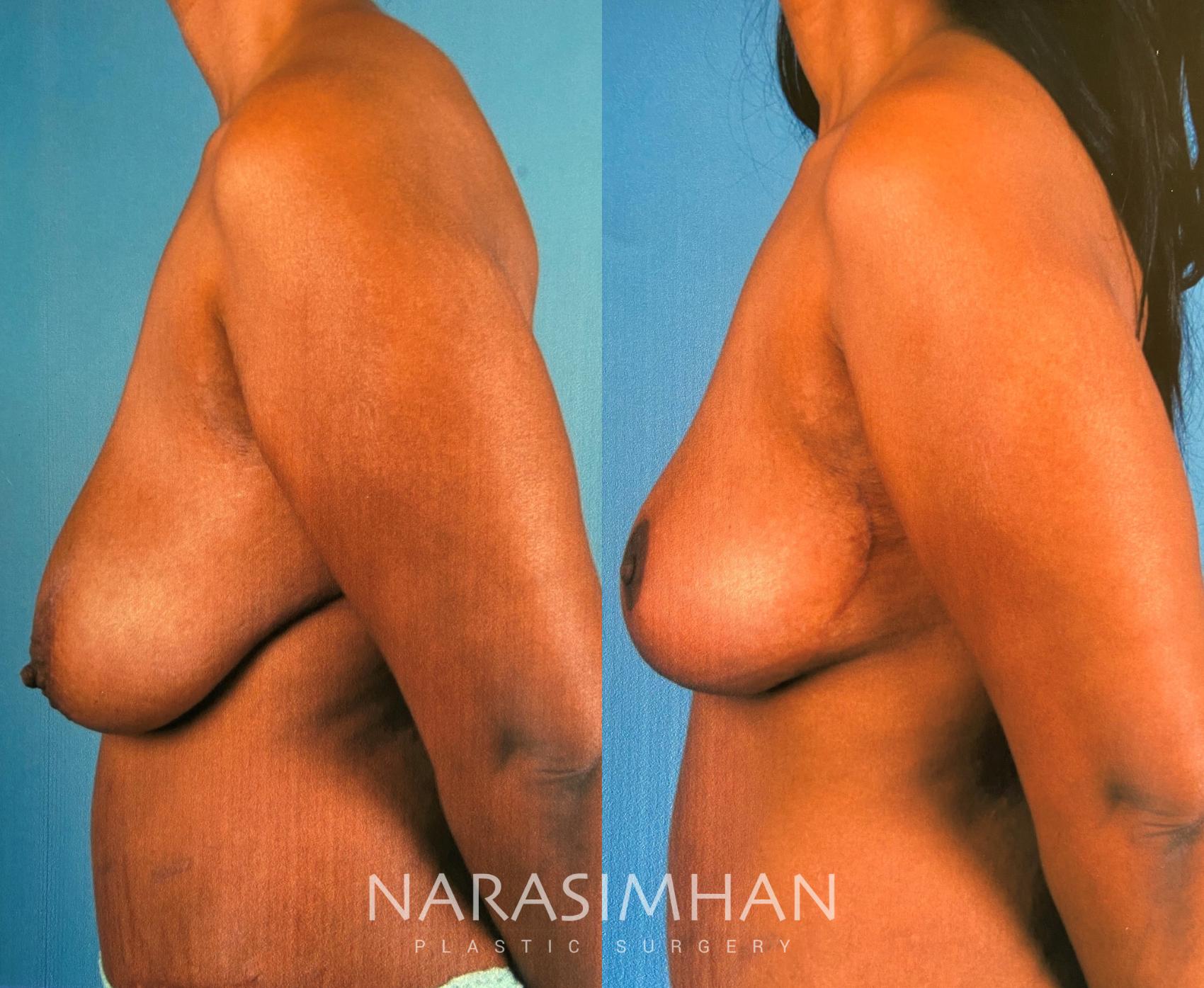 Before & After Breast Reduction Case 168 View #2 View in St. Petersburg, Florida
