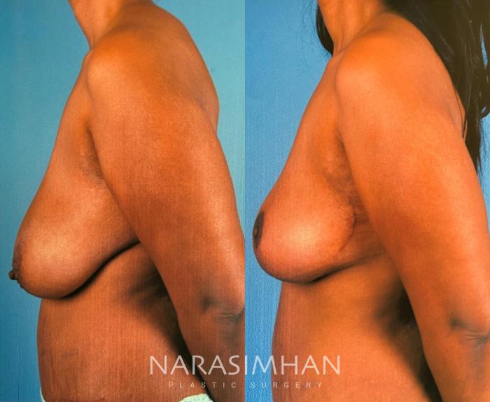 Before & After Mastopexy Case 168 View #2 View in Tampa, Florida