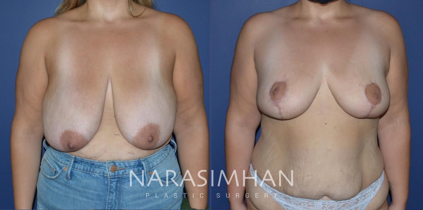 Before & After Mastopexy Case 218 View #1 View in St Petersburg, Florida