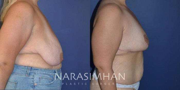 Before & After Post-Weight Loss / Post-Bariatric Skin Tightening Case 218 View #2 View in Tampa, Florida
