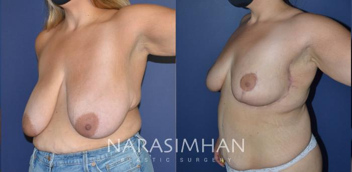 Before & After Post-Weight Loss / Post-Bariatric Skin Tightening Case 218 View #3 View in Tampa, Florida