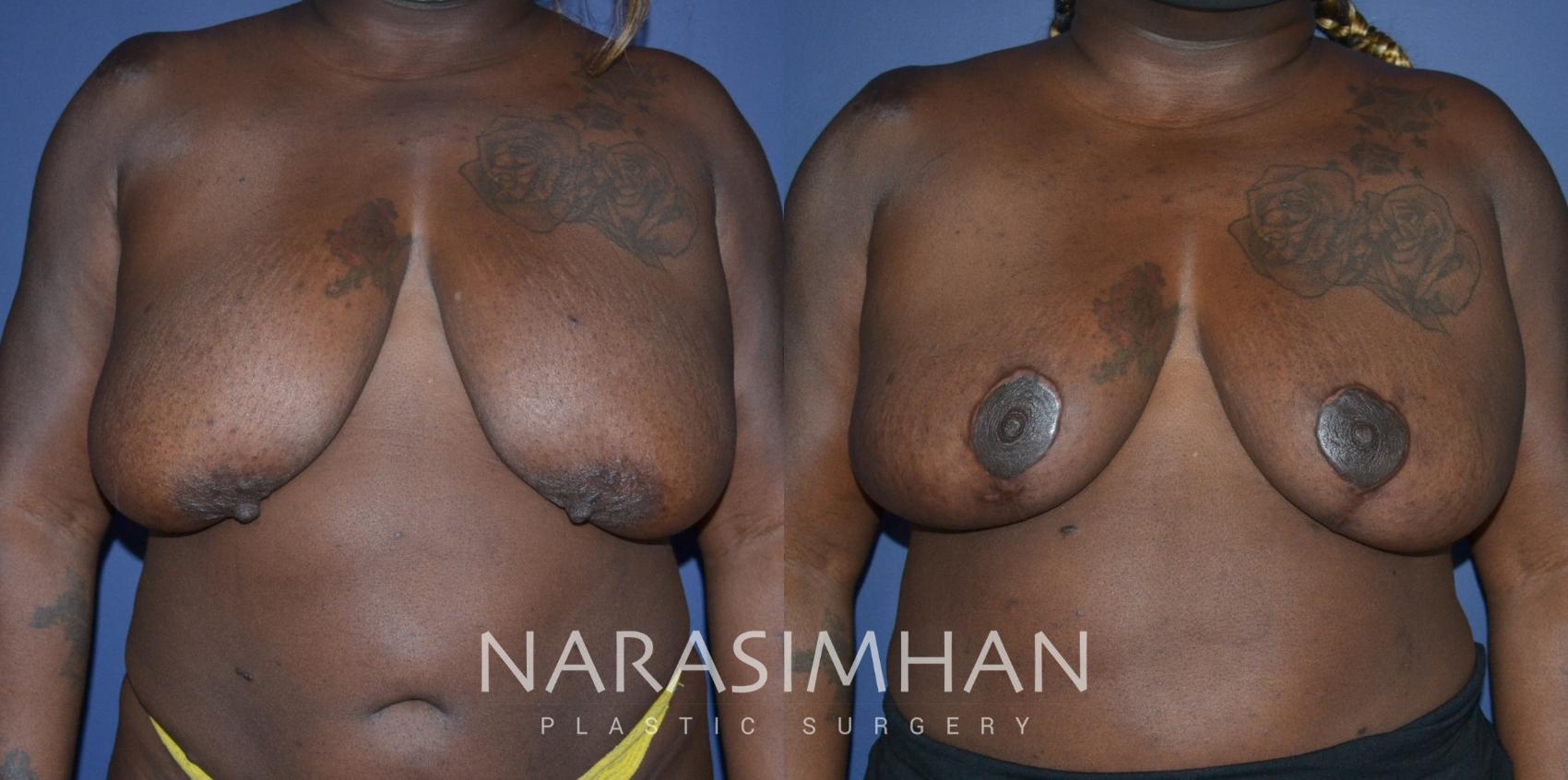 Before & After Breast Reduction Case 265 View #1 View in Tampa, Florida