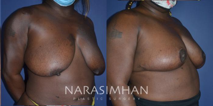 Before & After Breast Reduction Case 265 View #2 View in Tampa, Florida