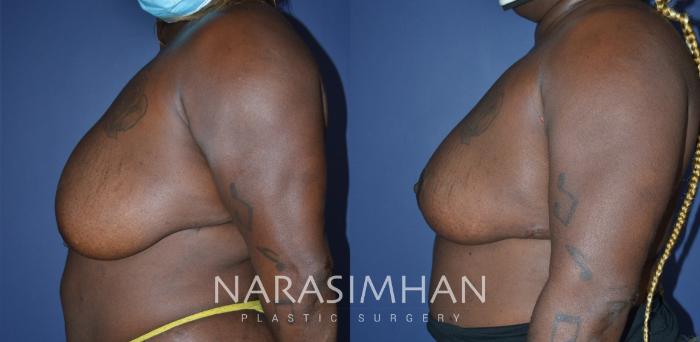 Before & After Breast Reduction Case 265 View #3 View in Tampa, Florida