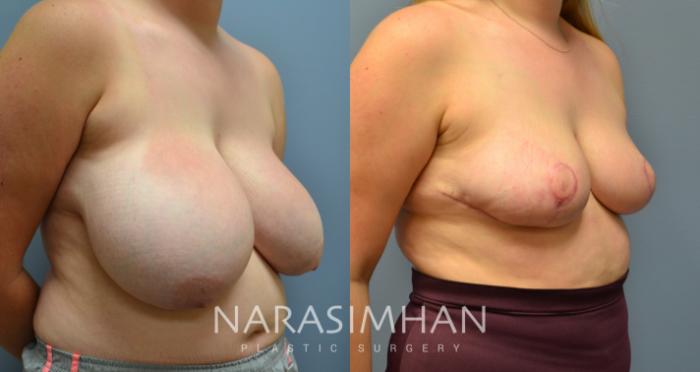 Before & After Breast Reduction Case 44 View #1 View in Tampa, Florida