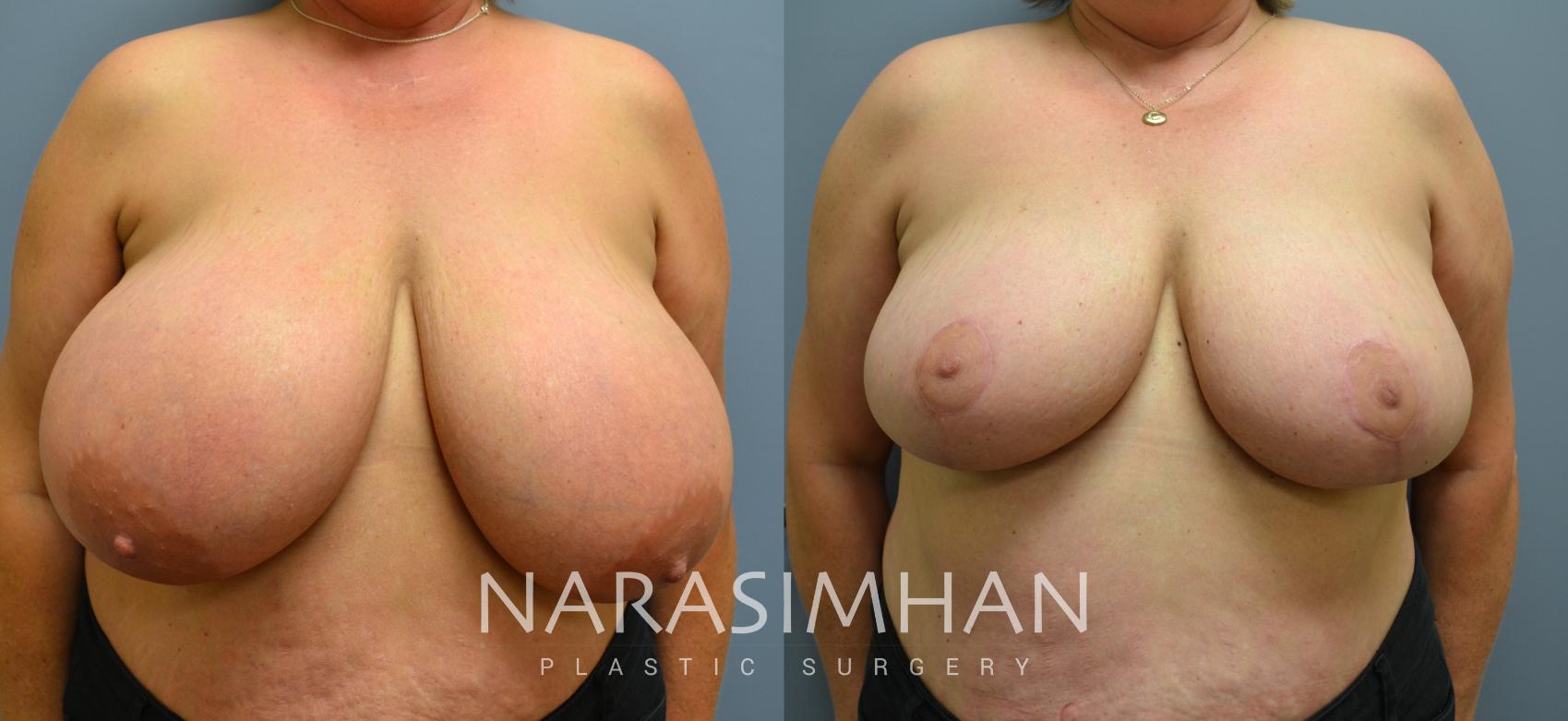 Before & After Breast Reduction Case 45 View #1 View in St. Petersburg, Florida